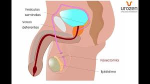 Urología guadalajara dr felix vargas. Reversion De La Vasectomia En Peru Urozen Youtube