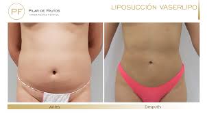 Los cambios que más notaron son: Que Tipos De Lipoescultura Y Liposuccion Existen Pilar De Frutos