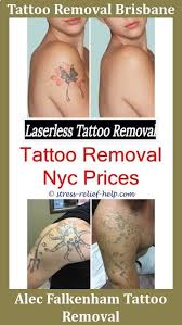 Pin On Tattoo Removal Help