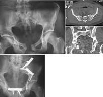 Anterior Plating of the SI Joint | Springer Nature Link