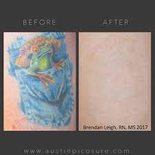 Get smooth at laseraway in austin, tx. Picosure Tattoo Removal Treatment Austin Med Spa