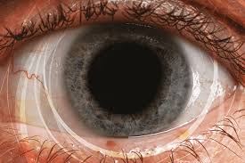 How Mesopic Pupil Size Affects Patient Outcomes