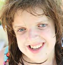 thankful for crouzon syndrome