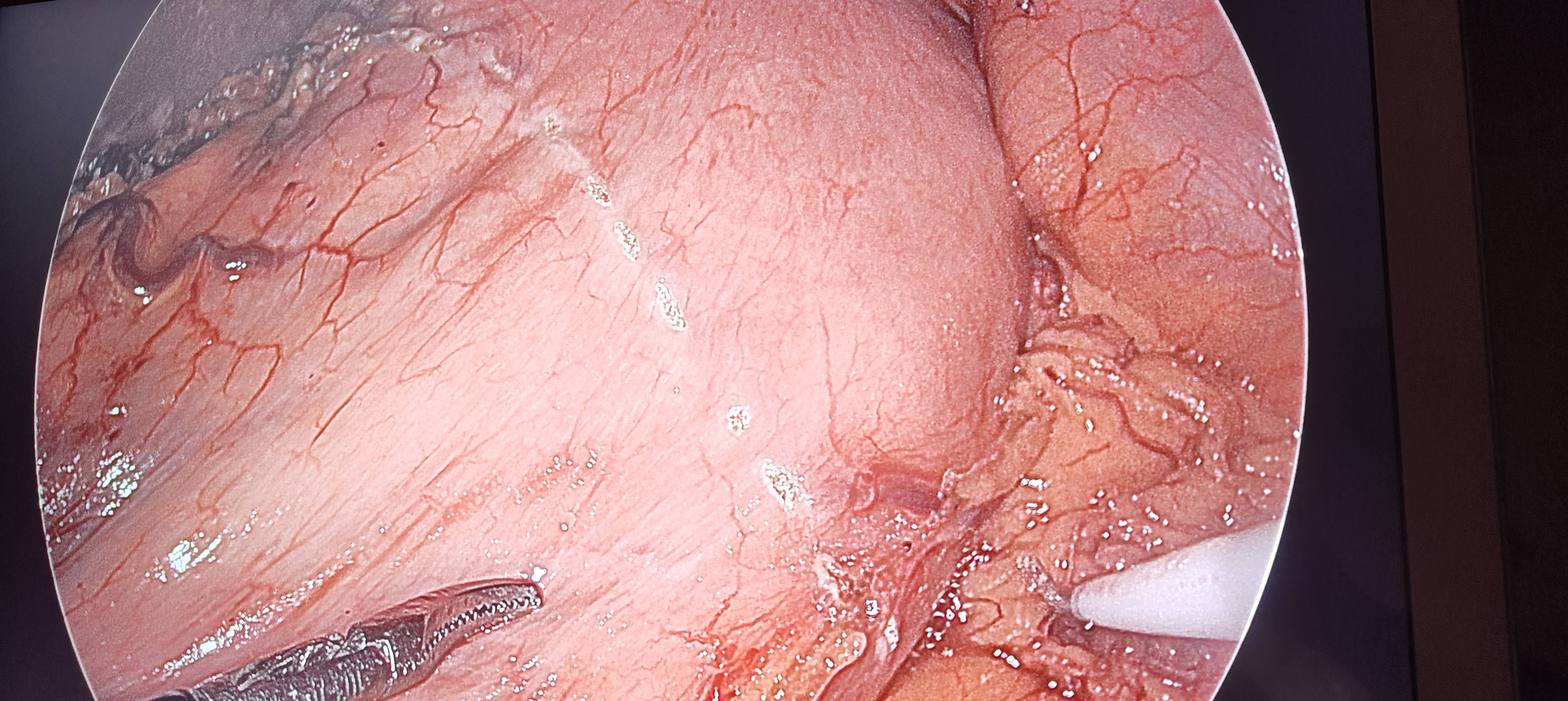 Laparoscopic Cancer surgery product image