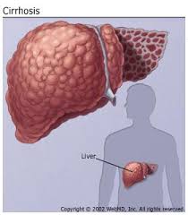 Allergies, autoimmune, & adrenal fatigue. Liver Cirrhosis Treatment Symptoms Symptoms Of Cirrhosis Of The Liver Include Fatigue Nausea Vomiting Loss Of Appetite Weight Loss And Abdominal Pain Debbie Schlussel