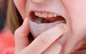 Buy high quality china products online.shopping beauty & health,cell phones,computer& networking and more on aliexpress.com Why Boil And Bite Mouthguards Are A Bad Idea Aesthetic Dental Denture Clinic