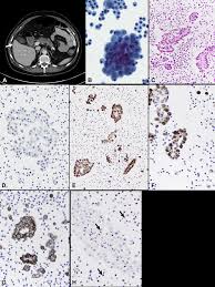 Histological testing of tumor tissue is still needed to confirm a mesothelioma diagnosis. Proceedings Of The American Society Of Cytopathology Companion Session At The 2019 United States And Canadian Academy Of Pathology Annual Meeting Part 2 Effusion Cytology With Focus On Theranostics And Diagnosis Of