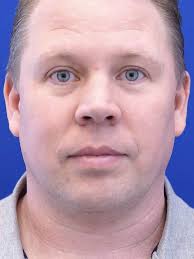 Mild Nasal Deviation 2930