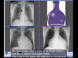 Chest X Ray Cardiomegaly Or No Cardiomegaly Water Bottle Sign Youtube