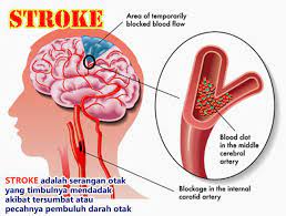 Cara merawat pendingin ruangan atau ac. Strokebolehsembuh Stroke Insyaallah Boleh Sembuh 100 Semulajadi