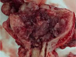 Oral cancer can be painless. Uterine Cancer Wikipedia