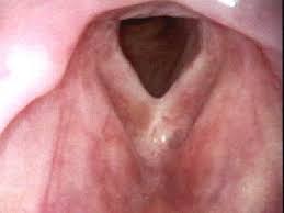 The wendler glottoplasty has the advantage that in the long term is the best result shown in relation to other techniques of voice feminization. Anterior Glottic Web Iowa Head And Neck Protocols