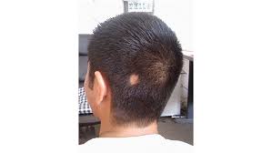 Genetic basis of alopecia areata: Everything You Need To Know About Alopecia Areata Currie Hair Skin And Nails