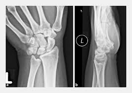 Https Www Handchirurgie Ravensburg De Fileadmin Benutzerdaten Handchirurgie Ravensburg De Pdf Publikationen Distale Radiuskorrekturosteotomie Indikation Therapeutisches Vorgehen Pdf