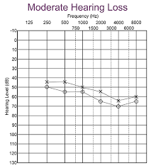 Ana anzola, principal audiologist at ascent audiology & hearing shows you how to interpret an audiogram, which is a graph showing the results of your hea. What Is An Audiogram Understanding Hearing Test Results Babyhearing Org