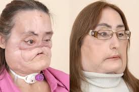 If i hadn't accepted this new face it. First Us Recipient Of Partial Face Transplant Dies Other Cases Of Face Transplants United States News Top Stories The Straits Times