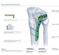 Proximal Lateral Tibial Locking Plate Ⅱ,Medical Device ...