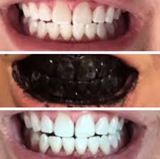 Utiliser la poudre au charbon uniquement une fois par jour et trois jours dans appliquer la poudre au charbon sur la brosse à dent en tapotant dans le pot. Poudre De Charbon Pour Blanchiments Des Dents
