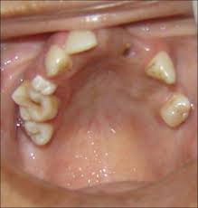 HIPODONCIA
