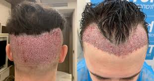 Maybe you would like to learn more about one of these? Nak Murah Punya Pasal Lelaki Mimpi Ngeri Lepas Tanam Rambut Di Turki Semasa Cari Infonet