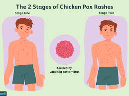 The chickenpox vaccine prevents almost all cases of severe. Overview Of Treatments For Chickenpox