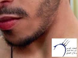 تجربتي بالصور مع بخاخ ريجين للذقن على مر الاسابيع المنتدى العربي لزراعة الشعر وعلاج الصلع