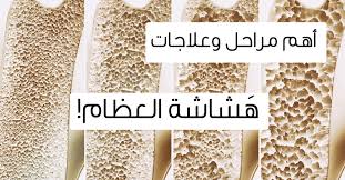 هشاشه العظام واعراضها تعرف على اعراض هشاشه العظام الحبيب للحبيب