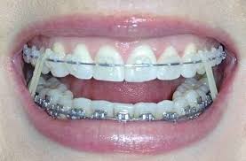Colorful neon designs on black background. Getting Braces Fitted Any Malocclusions In Your Teeth Can Be Fixed By Wearing Braces For A Given Amount Of Time Y Getting Braces Teeth Braces Dental Braces