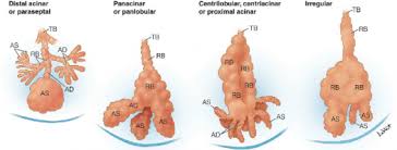 Emphysema Physiopedia