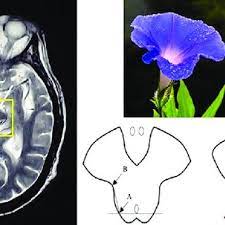 Pdf Humming Bird Sign Mickey Mouse Sign And Morning Glory Sign In Progressive Supranuclear Palsy