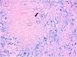 Methods retrospective review of nsclc. Misdiagnosis Of A Multi Organ Involvement Hematogenous Disseminated Tuberculosis As Metastasis A Case Report And Literature Review Infectious Diseases Of Poverty Full Text