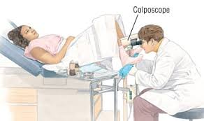 Image result for Colposcopy