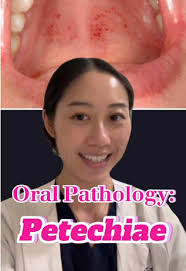 Image result for Physical injury red spots roof of mouth