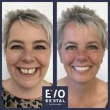 Full Mouth Dental Implants | Your Expert Options And Pricing