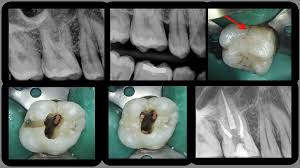 Image result for Pulpitis
