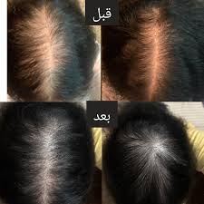 صور قبل وبعد استخدام الزيوت ♥️😭 اللهم بارك 😭♥️♥️#fypシ #mayasecretoils