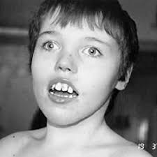 PDF) Disruption of a new X linked gene highly expressed in brain in a  family with two mentally retarded males