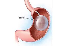 intragastric balloon gastric balloon