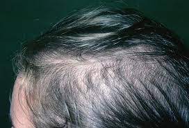 Strategy and tactics of diffusive hair shedding treatment. How To Treat Scalp Conditions That Trigger Hair Loss