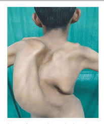 Anaesthetic Challenges And Difficult Airway Management In Noonan Syndrome Semantic Scholar