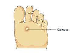 We did not find results for: Calluses And Corns Foot And Ankle Specialists