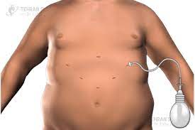 Scars are the body's way of healing a wound: Sleeve Surgery Scars Scaring After Gastric Sleeve Surgery