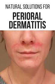 Perioral Dermatitis Your Ultimate Guide To Long Term Healing Dry Skin On Face Flaky Skin On Face Inflammed Skin