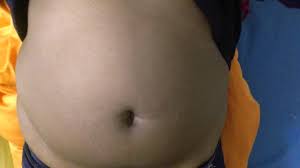 Manche krankenkassen bieten hilfe dafür an. Wie Kann Ich Mein Bauch Weg Kriegen Ich Hab Durch Die Mirena Zugenommen Abnehmen Bauchfett