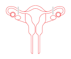 Many women finding out that a tubal reversal surgery is the most cost effective treatment to get pregnant after a tubal ligation. Tubal Ligation Procedure Female Sterilization Essure
