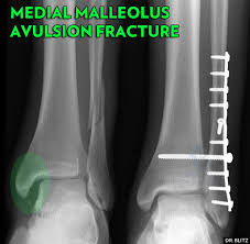 A fracture of the lateral malleolus above the syndesmosis joint constitutes a type c weber fracture, while below the syndesmosis joint it constitutes a type a weber these fractures are very unstable and require surgery as treatment. 5 Kinds Of Medial Malleolus Ankle Fractures