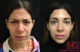 This is what happened when. How Baby Botox Helps Keep Your Baby Face