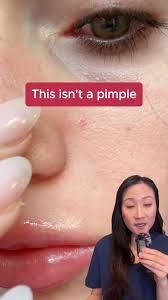 Image result for skin cancer on nose pimple