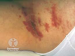 Image result for Candidiasis under breasts