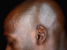 Crackling In Ear Causes Symptoms Remedies Treatment